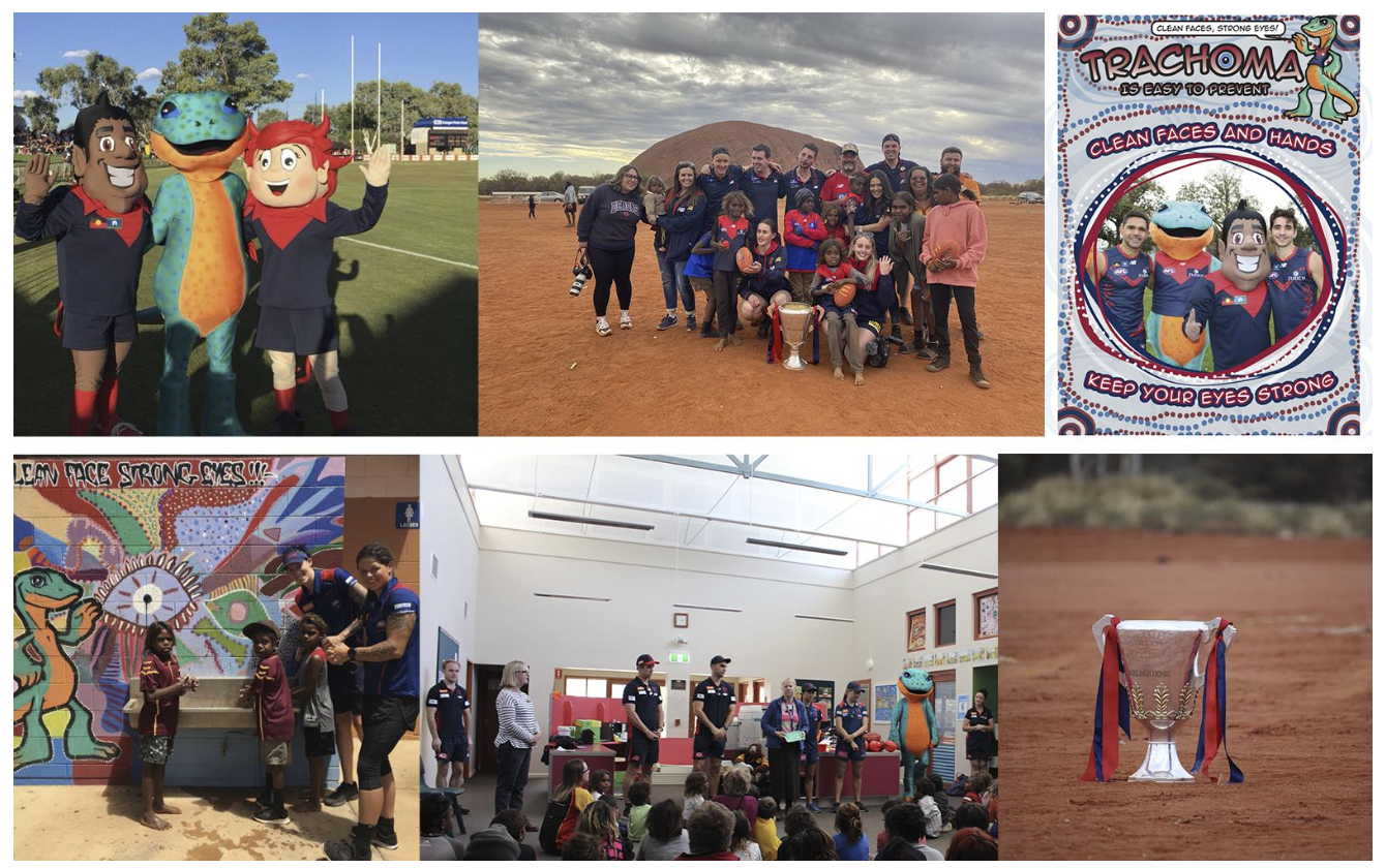 Melbourne Football Club (MFC) support for the elimination of trachoma